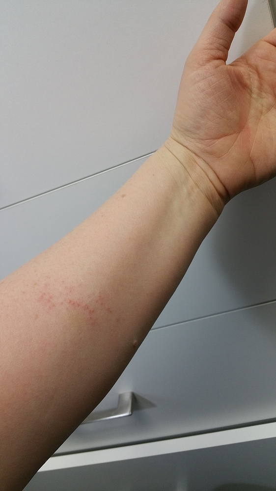 KETO rash Newbies Ketogenic Forums