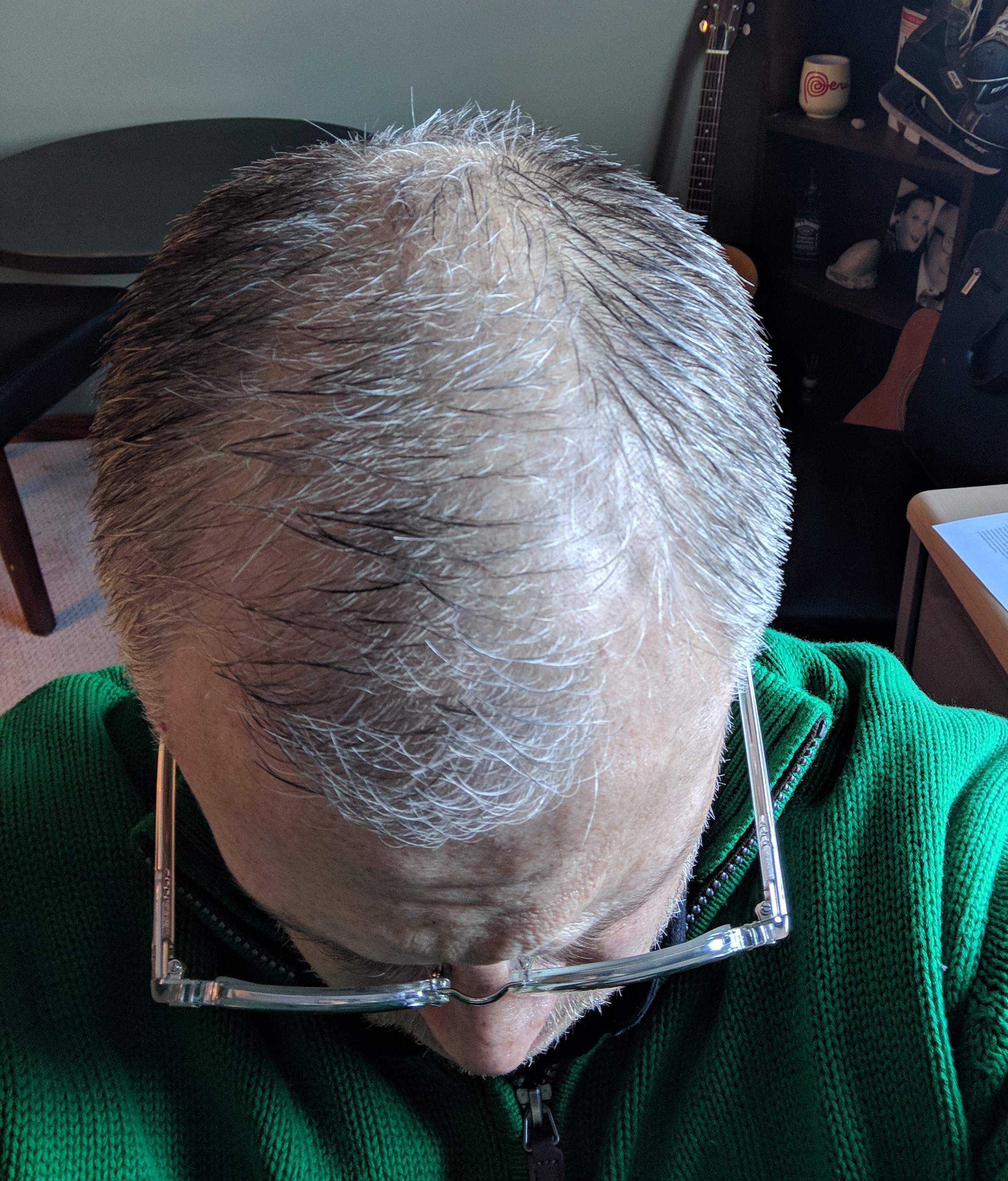 Thinning Hair - Ketogenic Forums